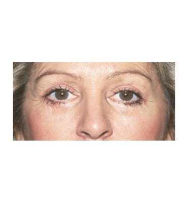 Tear-Trough Correction With Fat After